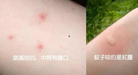 被跳蚤咬的图片